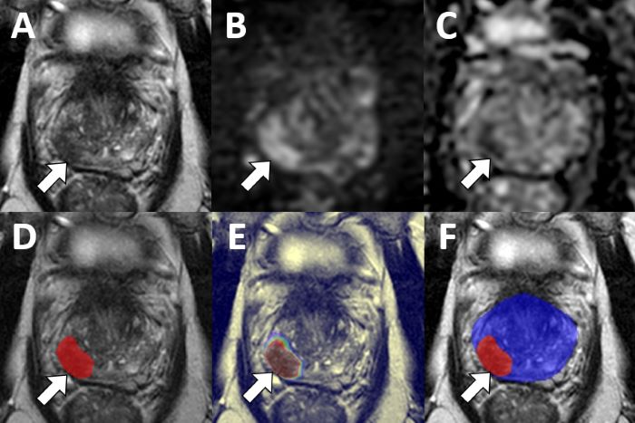 Standard MRI images (top row) of a patient’s prostate indicate a possible cancerous lesion. MRI images analyzed by an AI algorithm (bottom row) highlight the lesion with greater precision and with colors indicating the probability of cancer at various points. The physician diagnosed adenocarcinoma. 