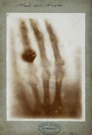First medical X-ray by Wilhelm Röntgen of his wife Anna Bertha Ludwig's hand