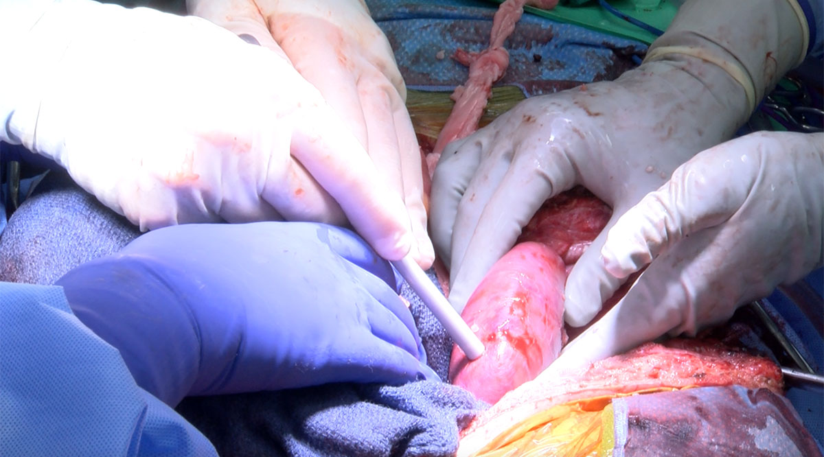 A pig kidney after being transplanted into a human by surgeons from UAB Heersink School of Medicine.