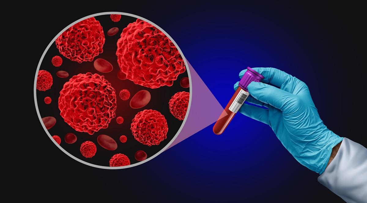 Blood Cancer screening Test as an Oncology medical diagnosis for tumor markers as a liquid biopsy for early detection with malignant cells to diagnose ovarian colon and prostate cancers.