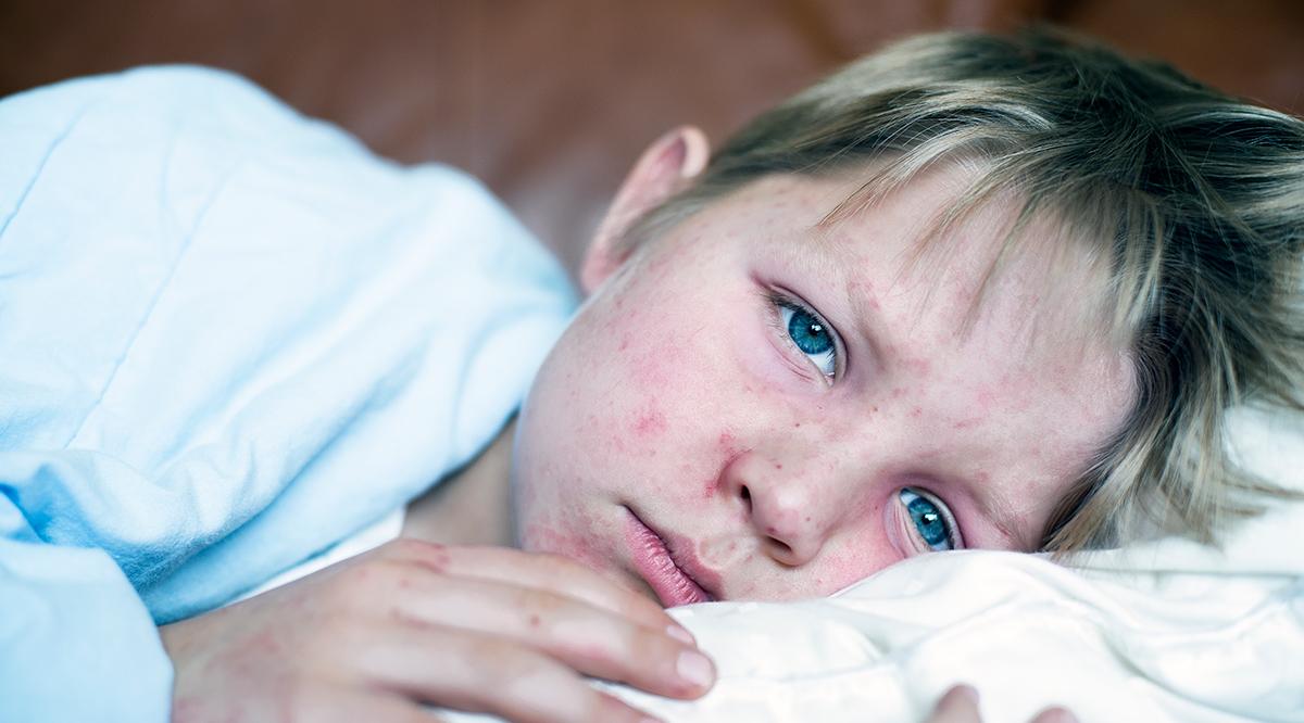Little boy fighting measles infection