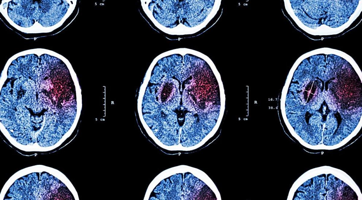 6-innovations-stroke-treatment-992x558px.jpg__992x558_q85_crop_subsampling-2_upscale