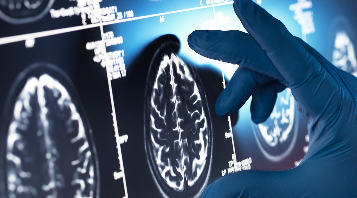 Doctor examining a human brain scan on screen