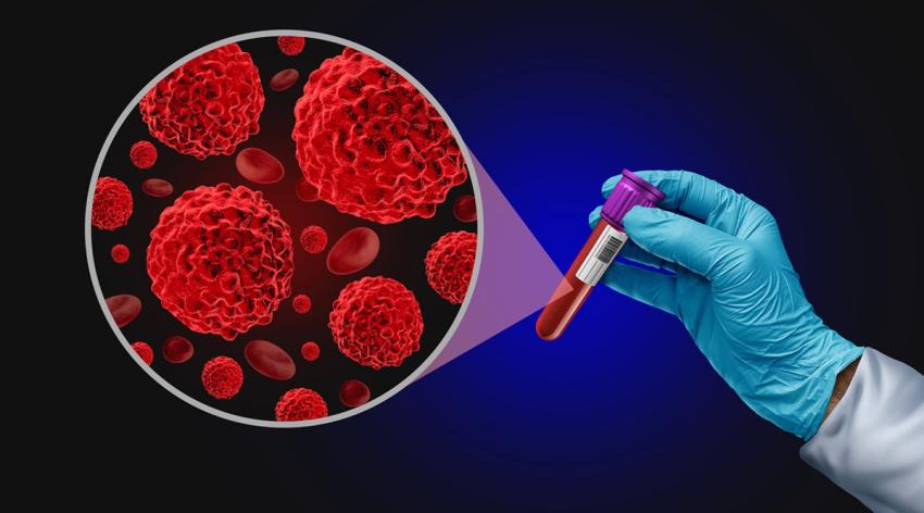 Blood Cancer screening Test as an Oncology medical diagnosis for tumor markers as a liquid biopsy for early detection with malignant cells to diagnose ovarian colon and prostate cancers.